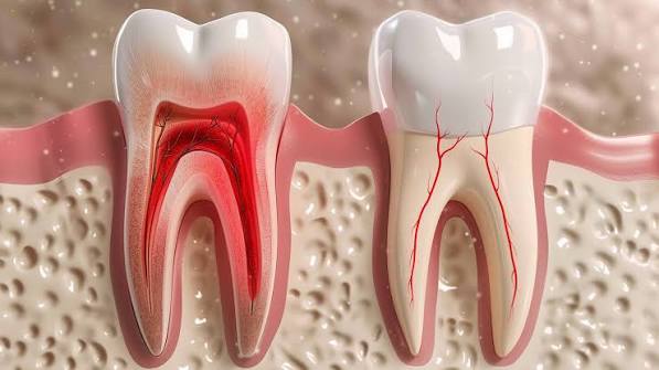 periodontit2 Лікування періодонтиту