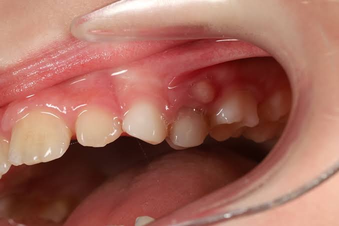 periodontyt Періодонтит