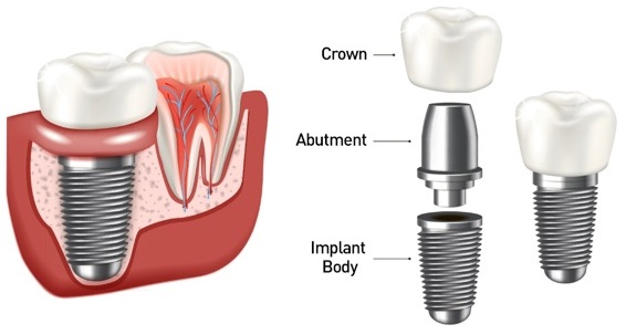 implant implant