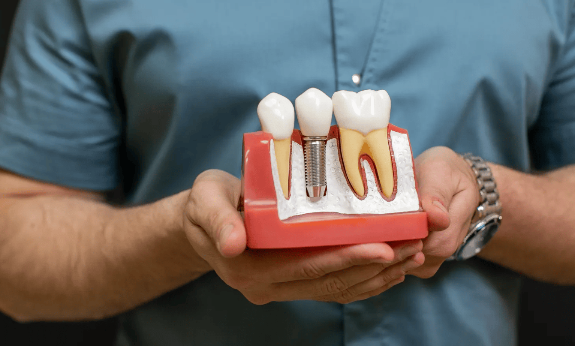 implant (1) Імплантація зубів в Одесі
