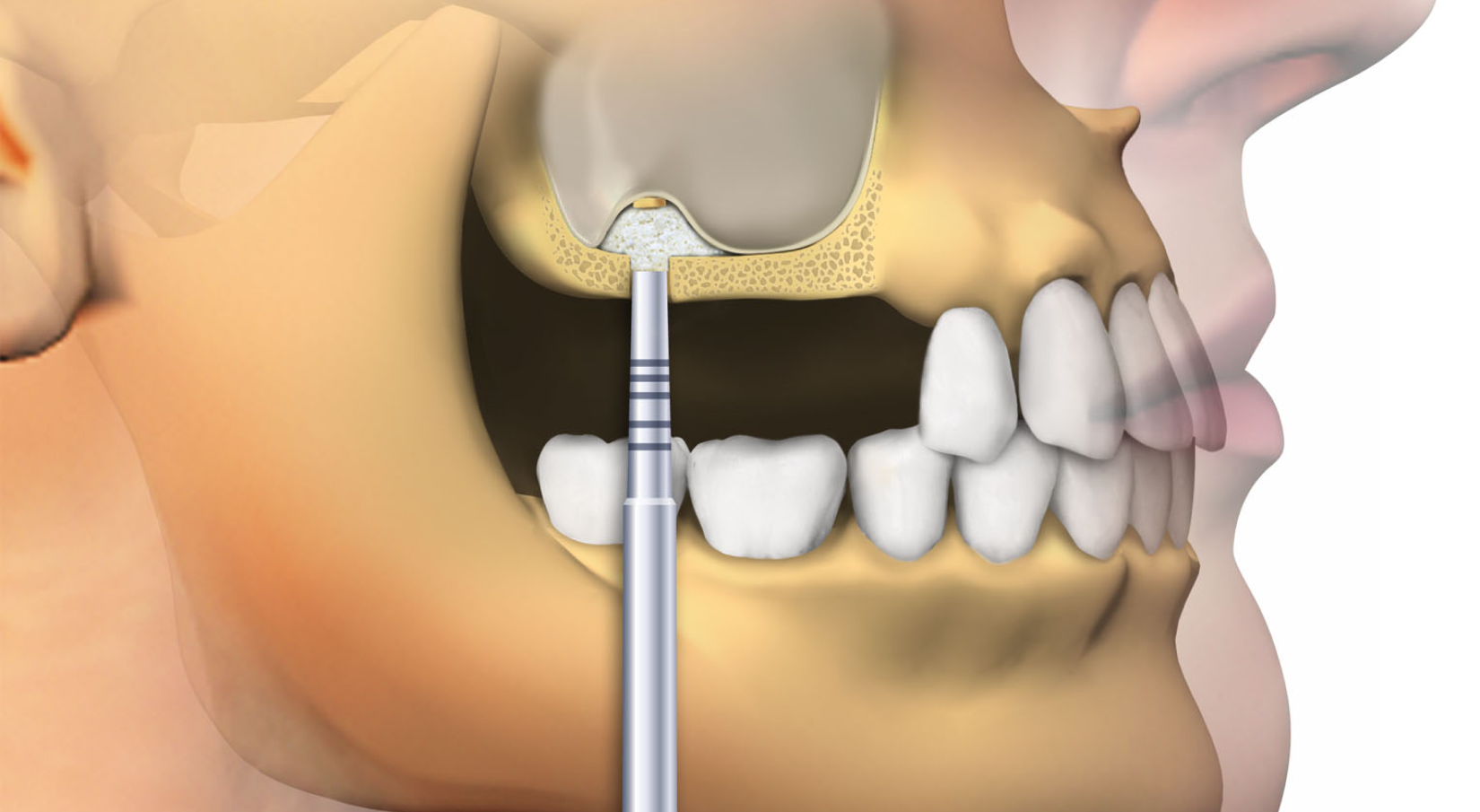 closeup-smiling-woma синус-ліфтинг в Одесі