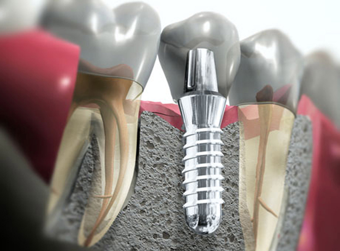 ymplantaczyya-zubov-systemoj-dentium-superline2 Який імплант для зубів обрати?